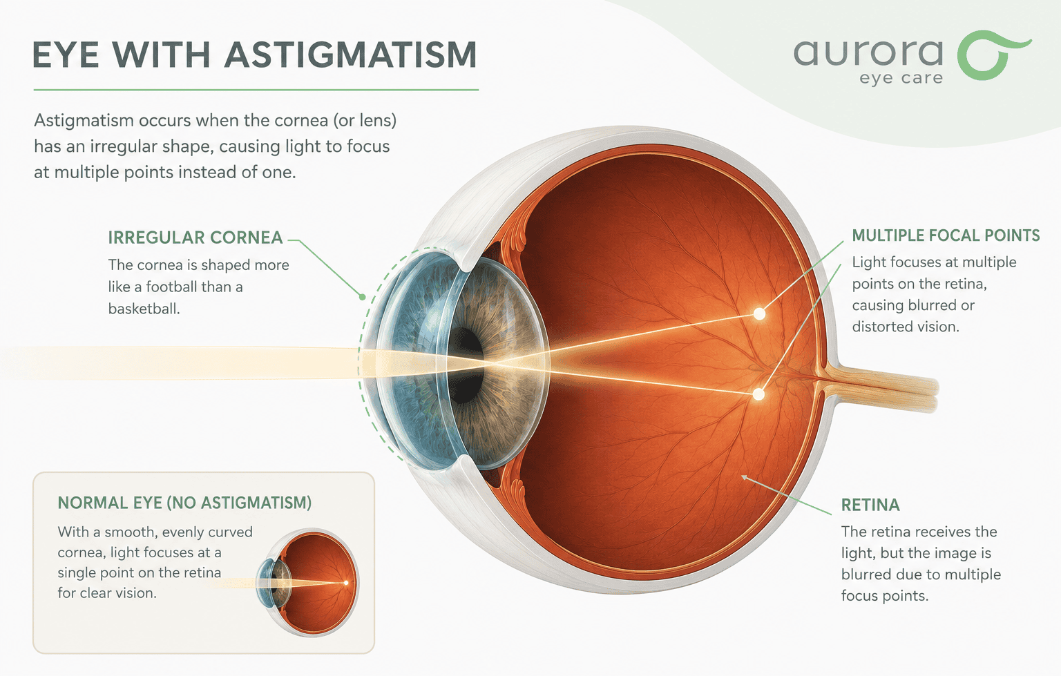 Astigmatism infographic